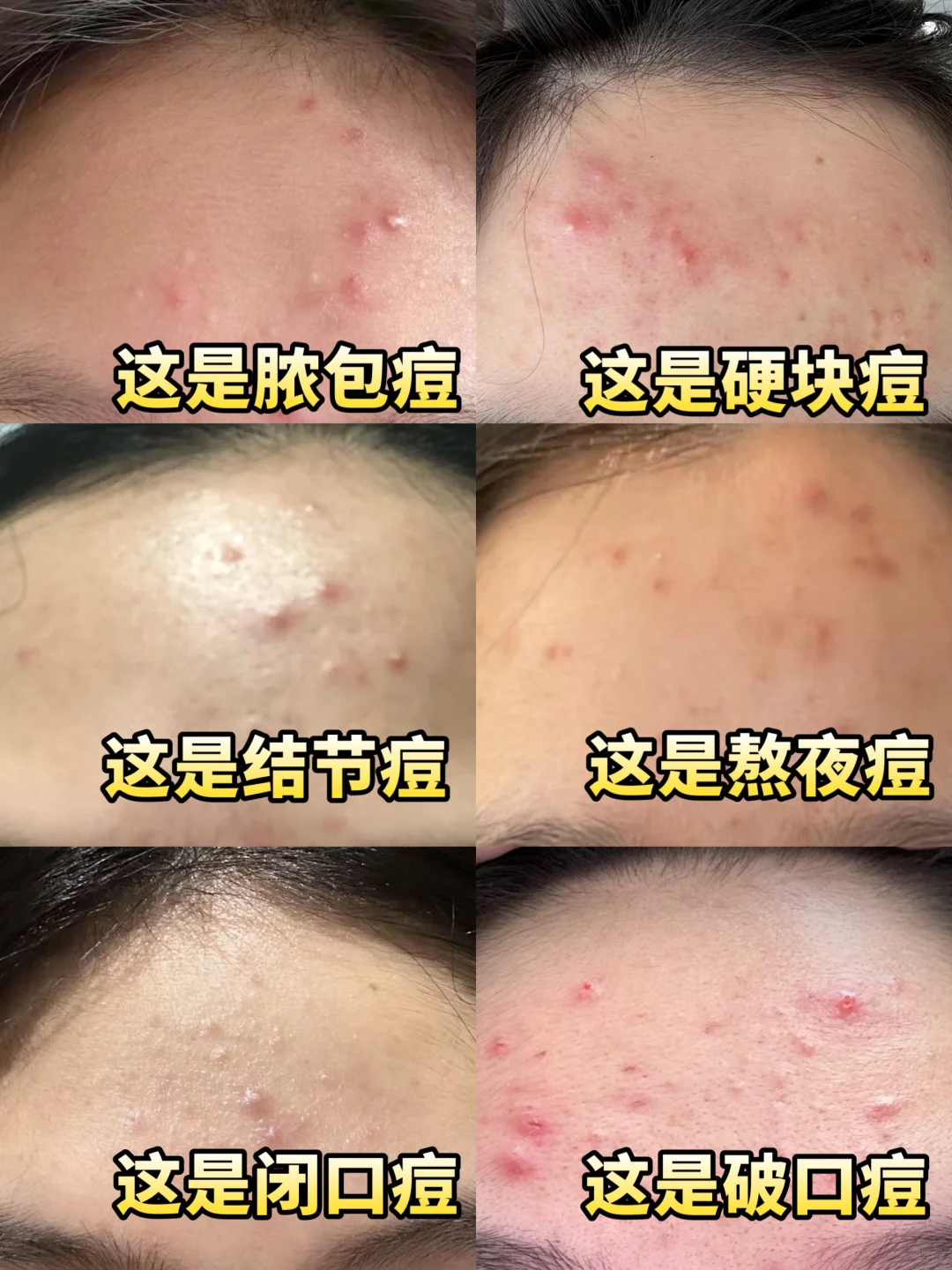 发现一个祛痘的99.9%成功率的方法！