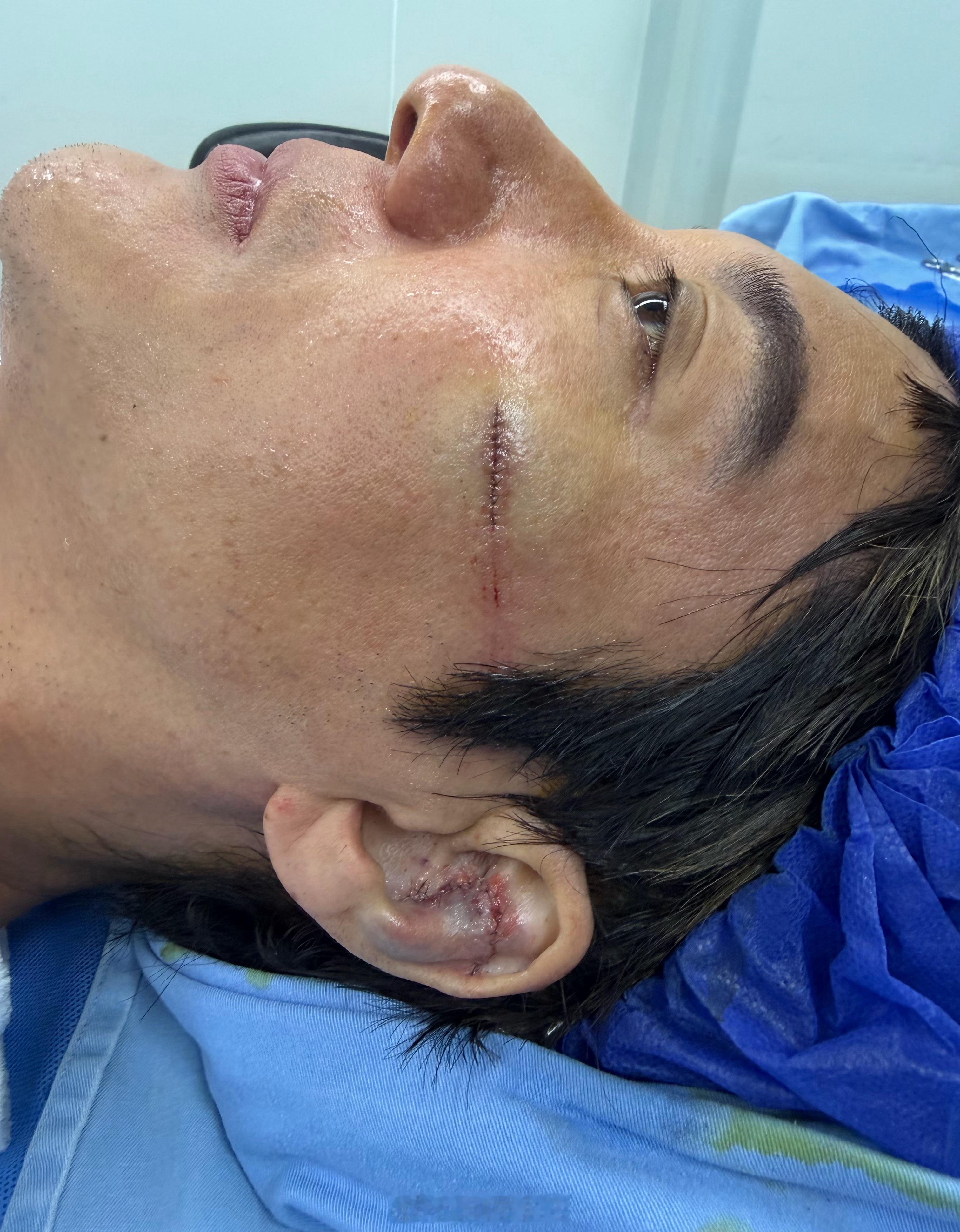 王力宏缝了39针 二哥别太拼，好好修养伤口，今晚取消吧