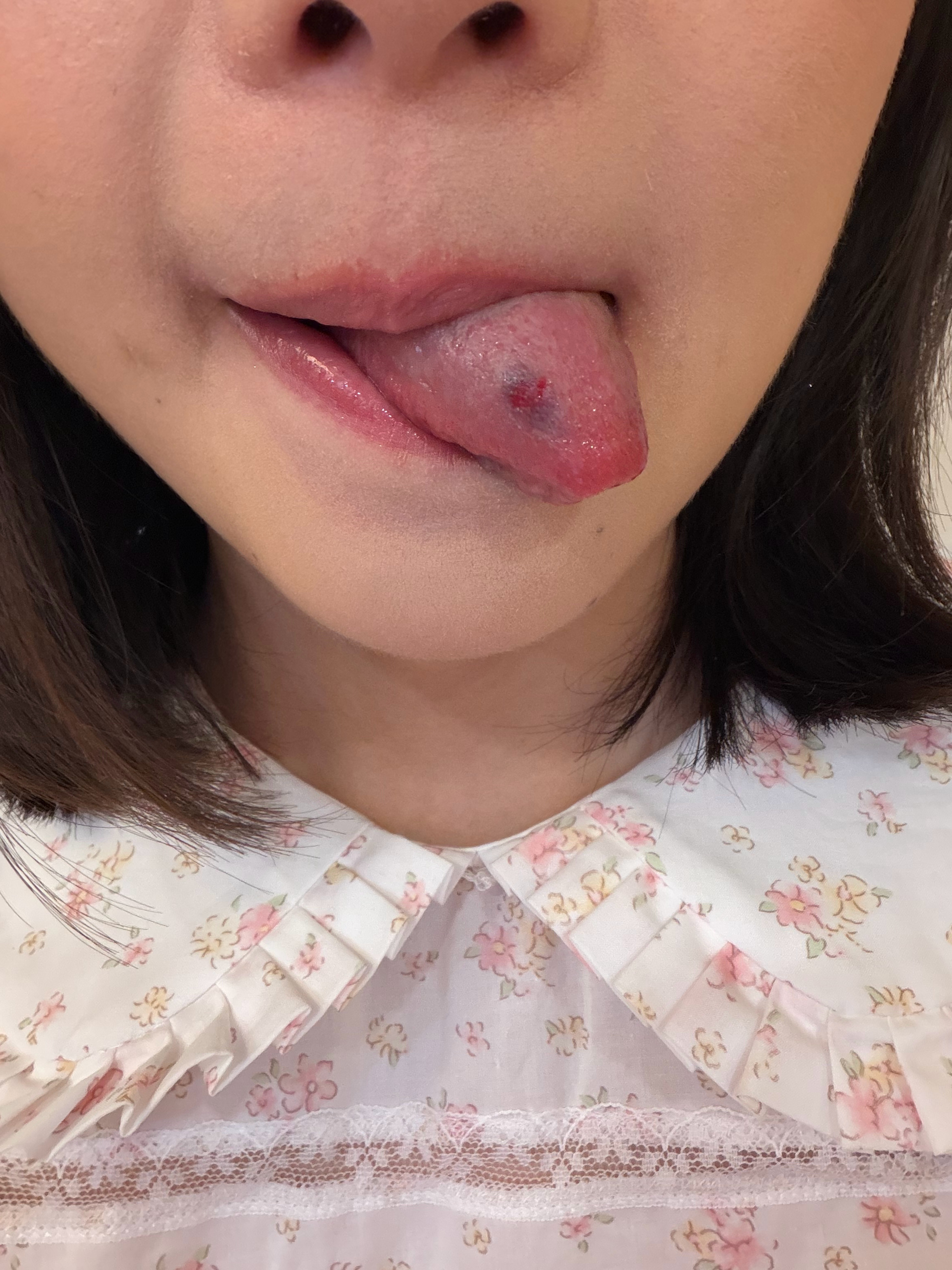 必须给孩子们展示一下被咬到的舌头 我滴妈 完全变异了