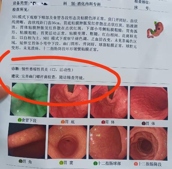 好好的胃为什么会变成萎缩性胃炎？
慢性萎缩性胃炎是慢性胃炎的一种类型。“萎缩”并
