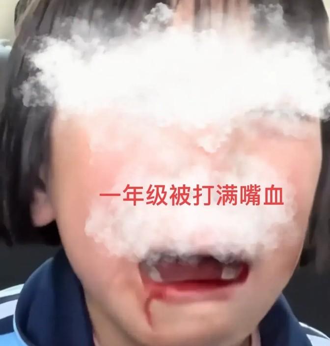 突发！一年级女生被同学霸凌，满嘴是血，且不让找老师 网友炸锅
校园霸凌，这个词听