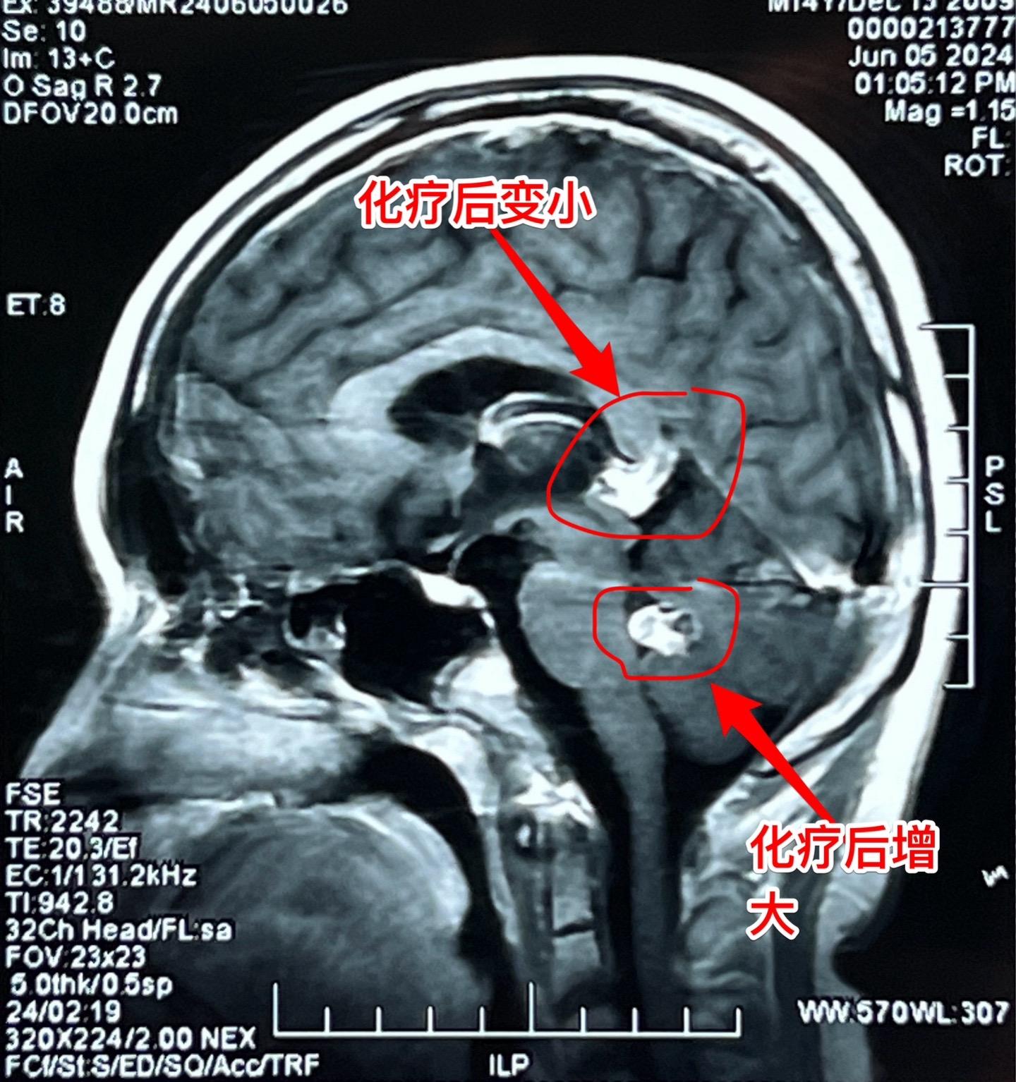 脑部生殖细胞肿瘤一般需要综合治疗。14岁广东省男孩子发现松果体区及第四脑室内多发肿瘤，怀疑是生殖细胞肿瘤。在广州市某医院作了两个疗程的化疗，松果体区的肿瘤明显变小了，但是第四脑室内的肿瘤体积却增大了！
       昨天为他作了开颅手术，看见第四脑室内的肿瘤病灶一共有四个，切除了三个，另一个经过化疗后似乎坏死了！等病理报告出来后还需要综合治疗。
       恶性的生殖细胞肿瘤一般需要综合治疗，该男孩子病灶有播散转移，应该是恶性肿瘤，为病人祈福🙏。