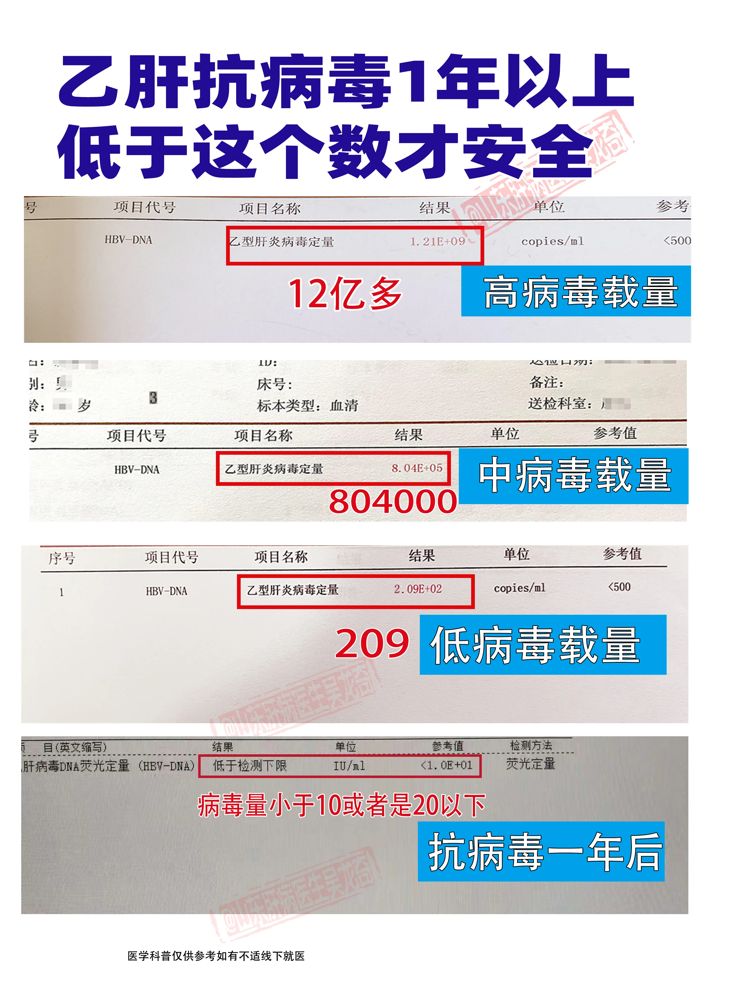 乙肝病毒量等级越高，病毒复制越活跃，传染性越强！希望大家抗病毒1年以上...