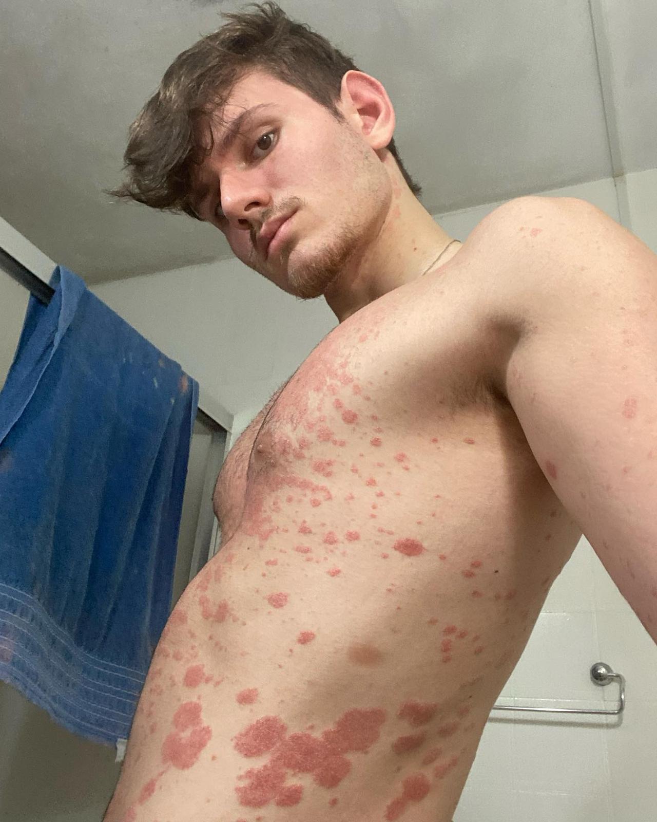 João Guerreiro 得了银屑病，一种慢性、非接触性疾病，会导致红色和