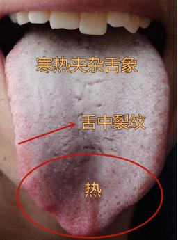 舌面像铺了一层白雪，白花花的一片，脾肾虚成这样，那方面功能一定不会好！
 
今天