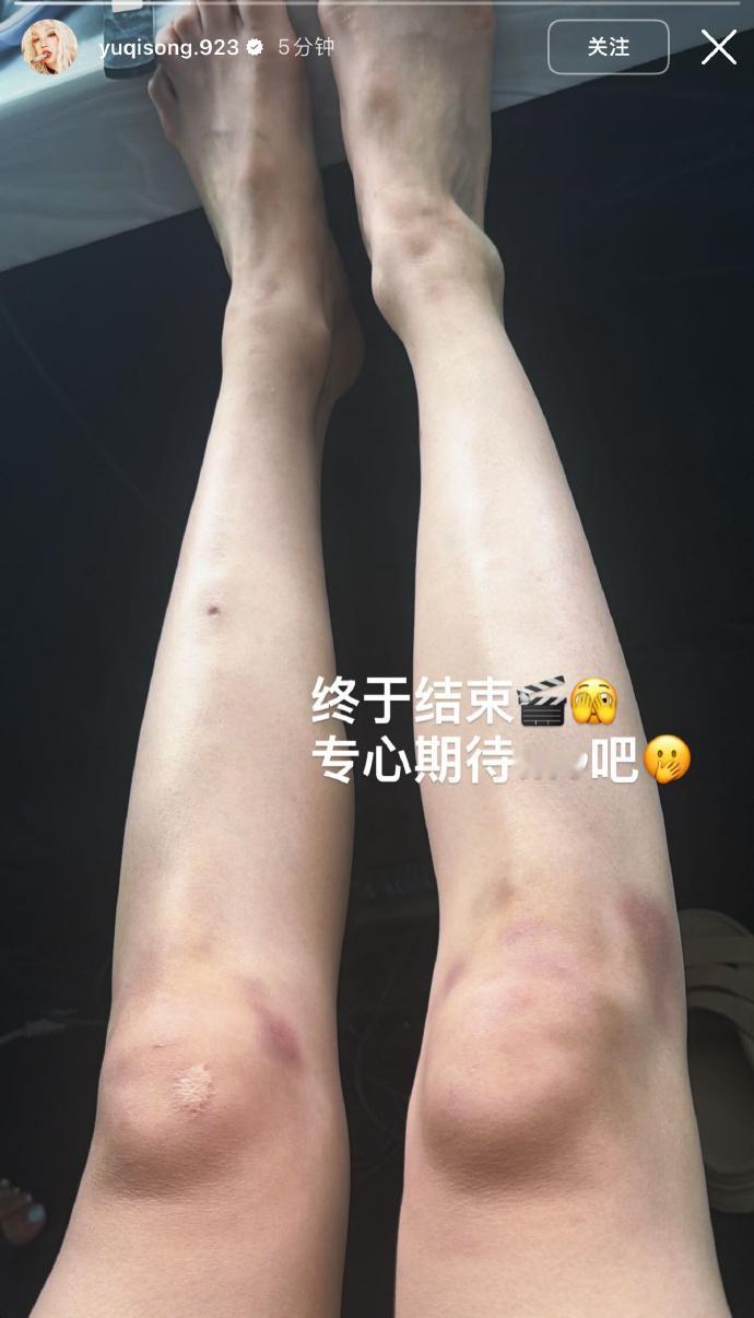 宋雨琦疑似回应恋情宋雨琦发布ins快拍分享mv杀青日常，膝盖上面满是拍摄造成的淤