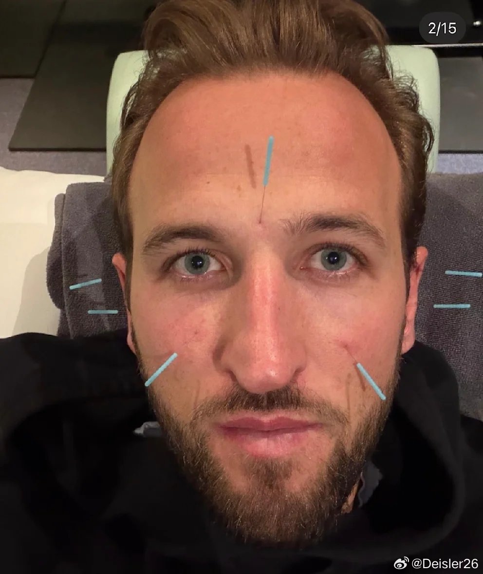 🚨［圖片報］：哈利·凱恩不僅依靠拜仁慕尼黑的醫療團隊和體能教練，他也諮詢西班牙