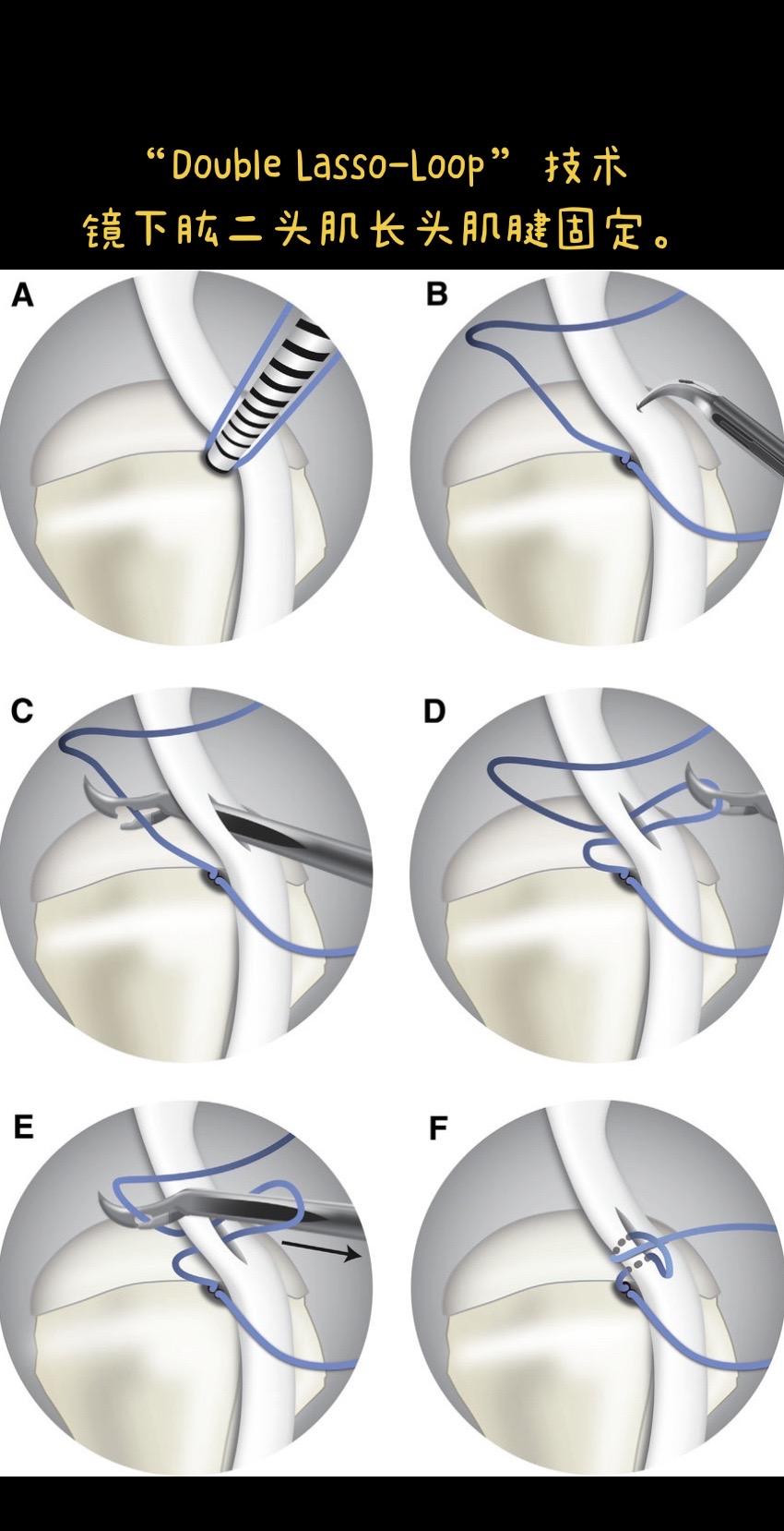 双套锁-环技术。“Double Lasso-Loop” 技术，关节镜下...