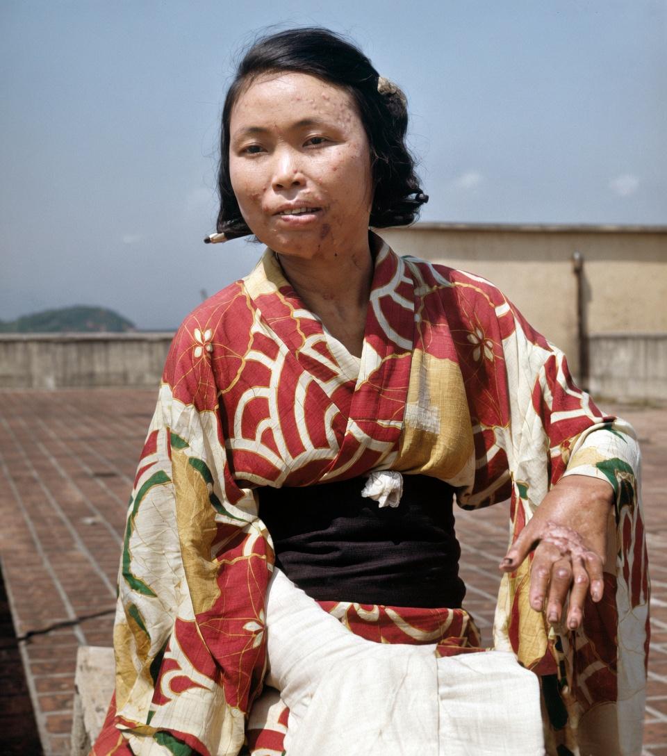 这张照片中的女性，是广岛原子弹爆炸的幸存者，她身上的疤痕是1945年8月6日那场