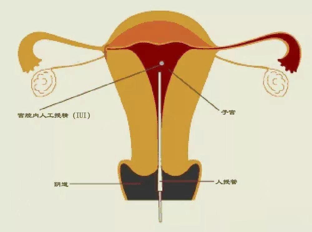 人工授精是怎么回事？怎样做人工授精？#女性健康必修课# 人工授精是指收集男方的精