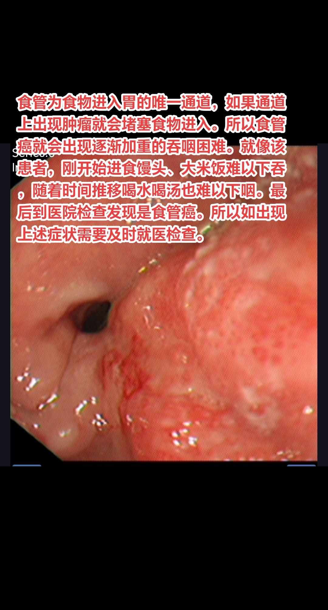逐渐加重的进食困难需要警惕食管癌。食管为食物进入胃的唯一通道，如果通道...