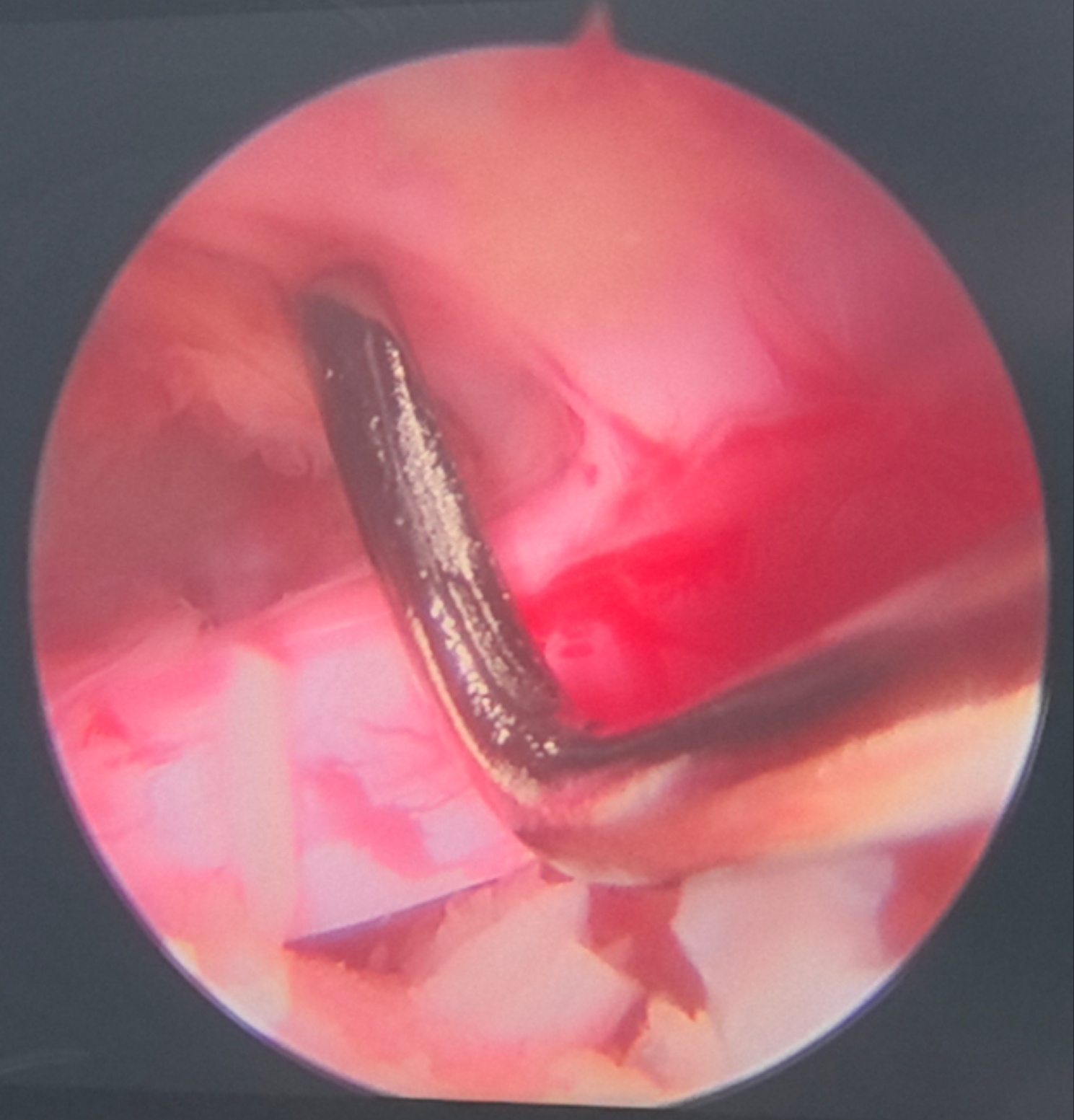 保守治疗一年后神经受压变细了。小伙子一年前腿就麻了，最近疼痛难忍，手术中发现神经