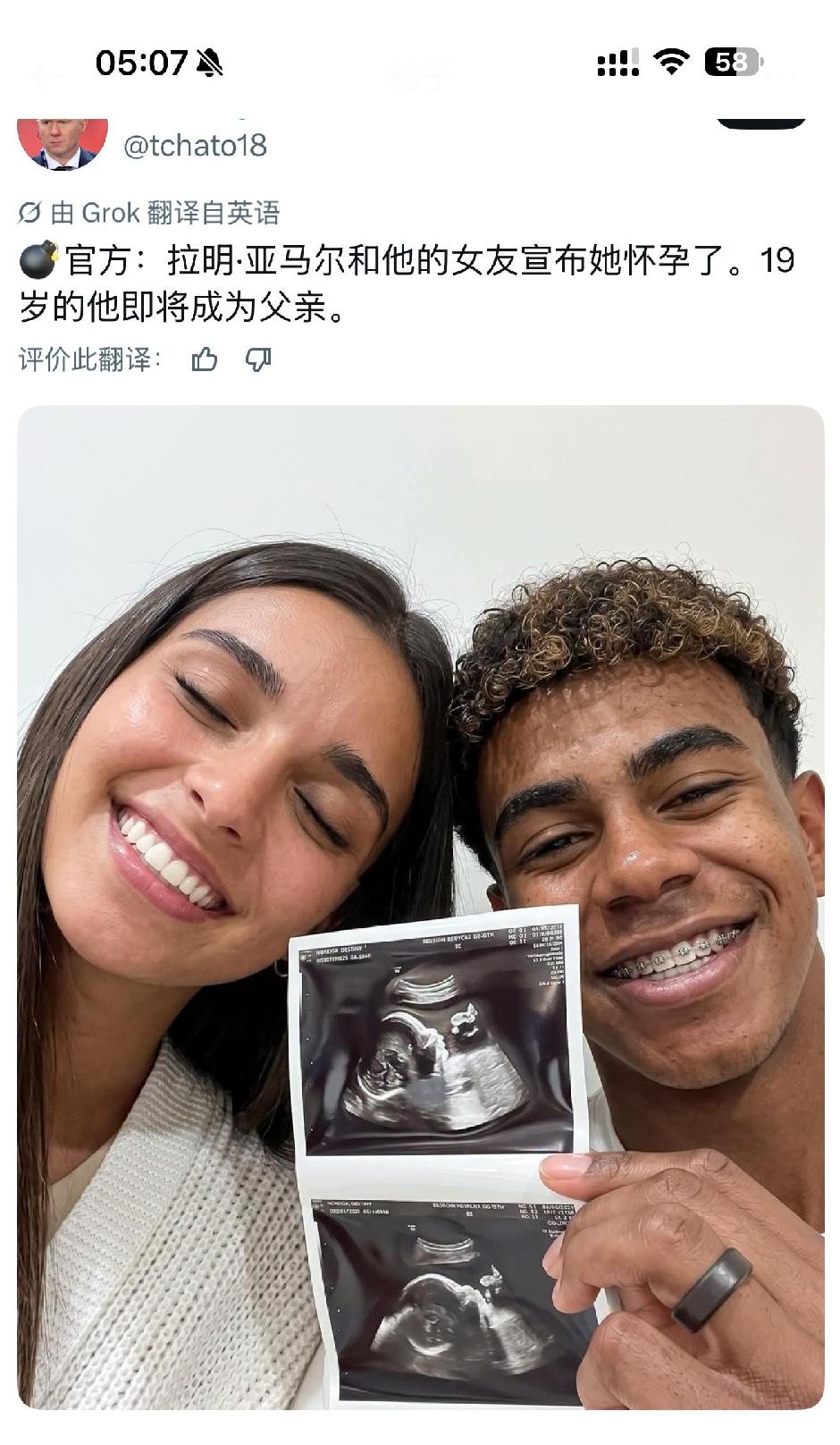 哇哦，年仅19岁的足坛新王亚马尔要当父亲了！

镜头中戴着牙套的亚马尔浓眉深目，