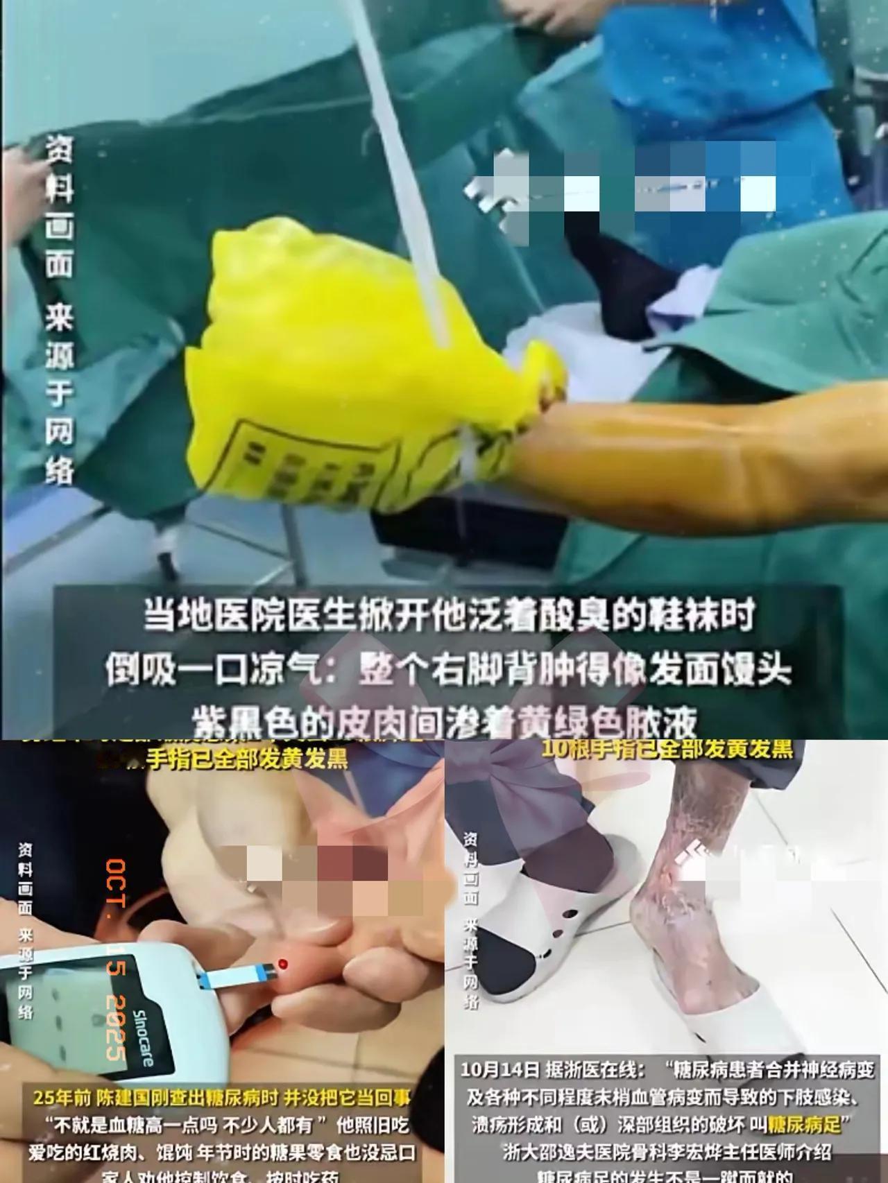 浙江的陈先生因为糖尿病，饮食方面平时不忌，药物也不按时服用。
 有一天剪脚趾甲时