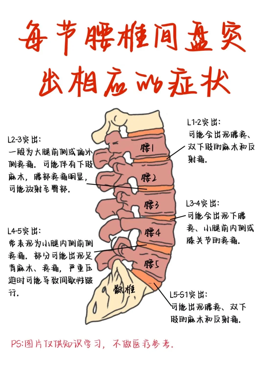 医学生笔记——腰椎间盘突出