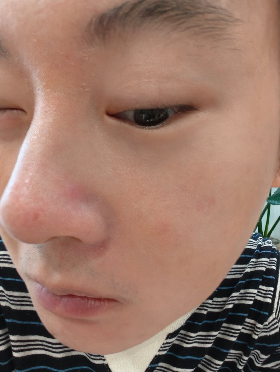 我说我鼻子怎么歪了，原来是爆了个痘贴胶带贴的，不贴又会增生 
