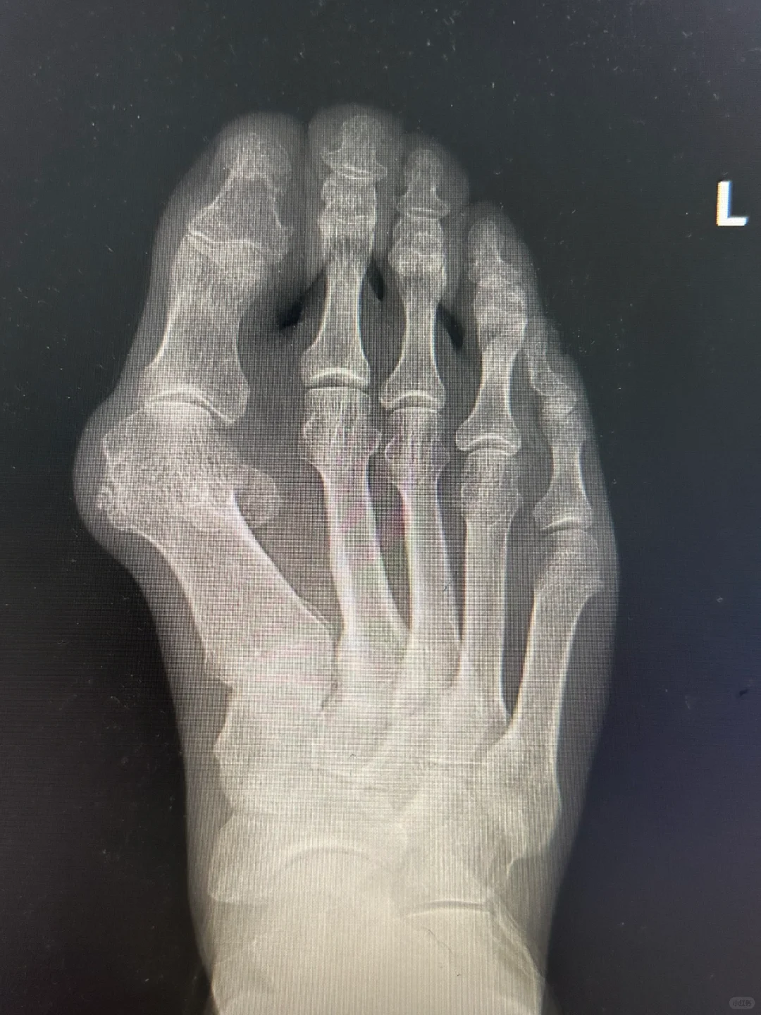 拇外翻手术三部曲