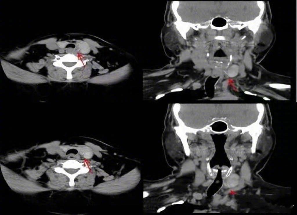 年年有余，是种美好的祝愿！所以除夕夜，家家户户都会吃鱼！吃鱼就难免被鱼刺卡住。我