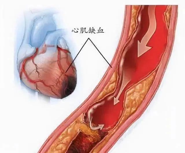 身体5个表现，可能是心肌缺血了！两味中药煮水喝，恢复心脏供血

心肌缺血常发生在