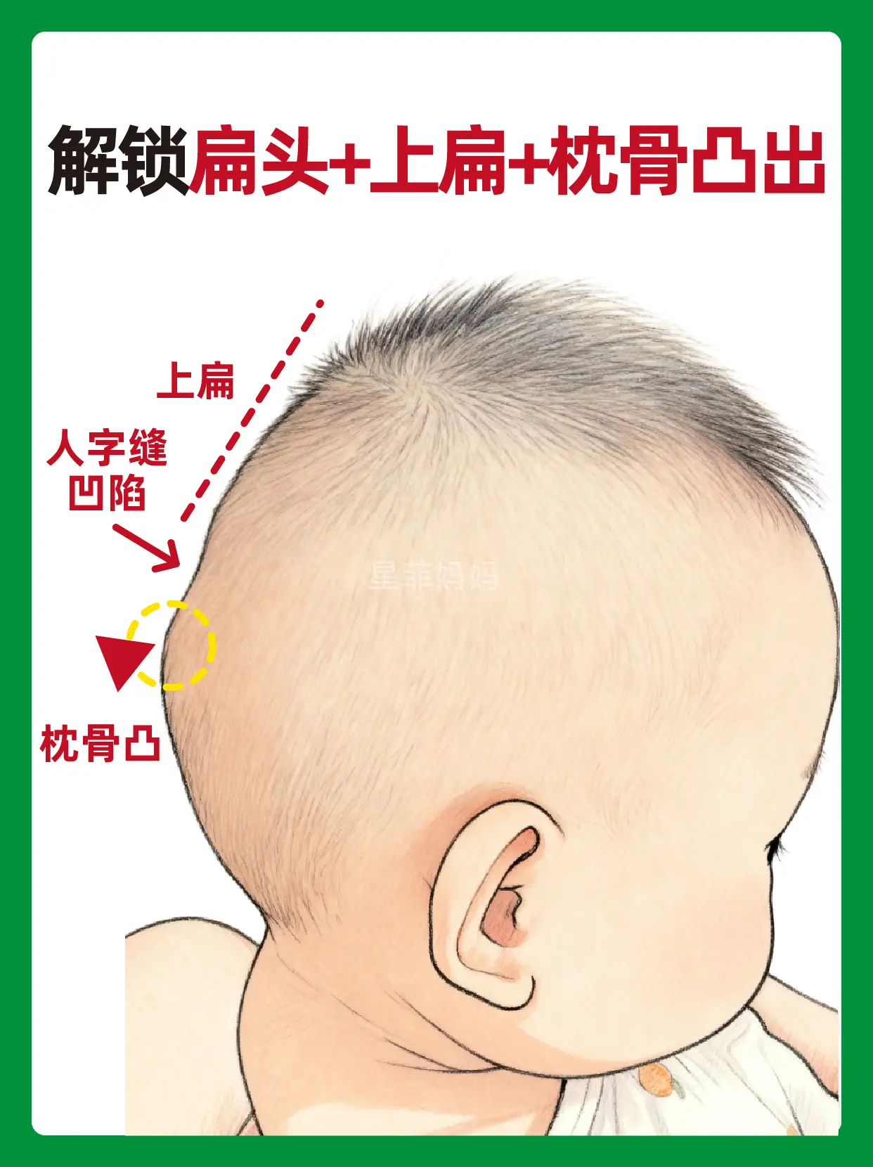 扁头+上扁+枕骨凸出调整方法。