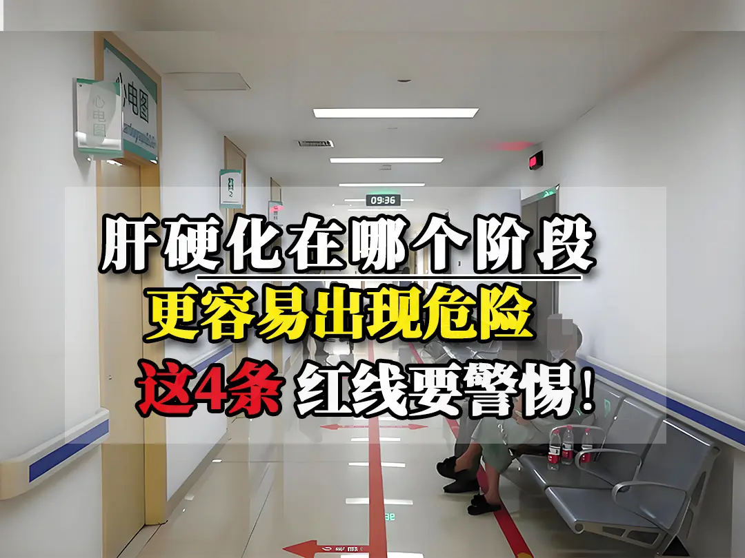近日接诊了一位安徽的患者，乙肝10几年，没有重视，查出肝硬化1年多了...
