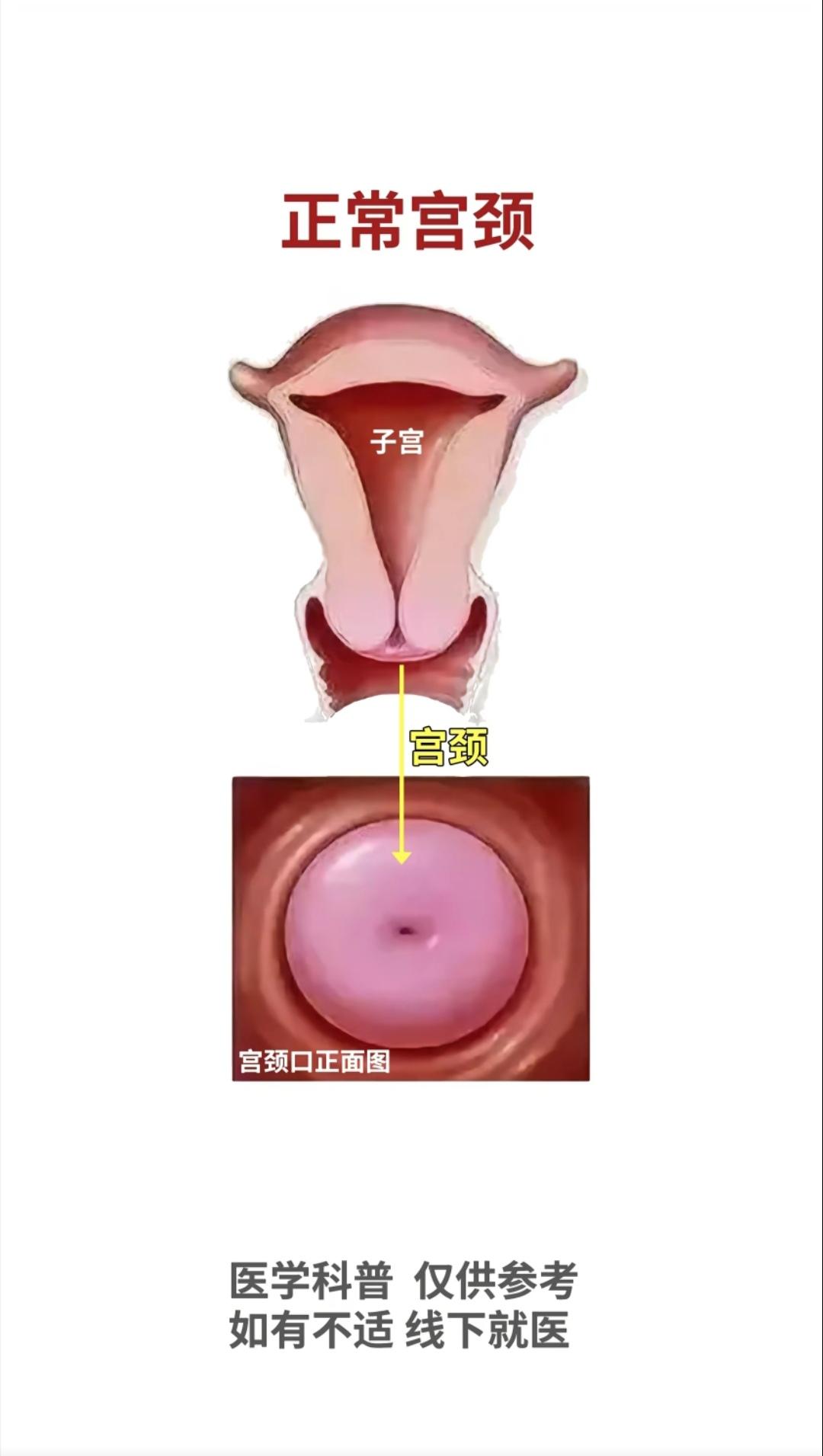 宫颈癌的演变过程。