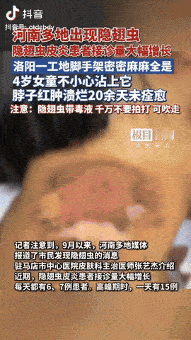 河南洛阳，一工地脚手架上，竟然密密麻麻爬满了隐翅虫，4岁小孩不小心沾上它，导致她