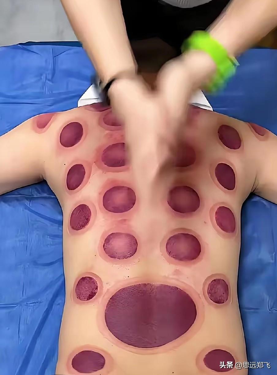 火罐也太吓人了吧？
拔成这个样子
我不觉得是健康的，这有点拔苗助长的味道！

