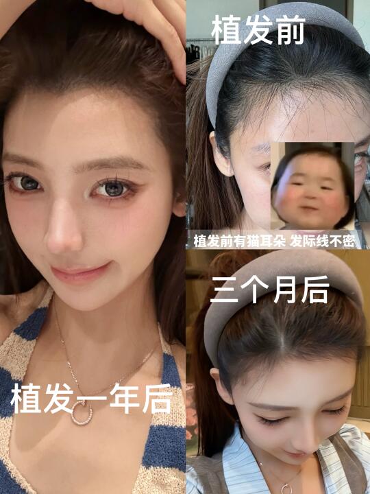 最后悔的就是不剃发植发