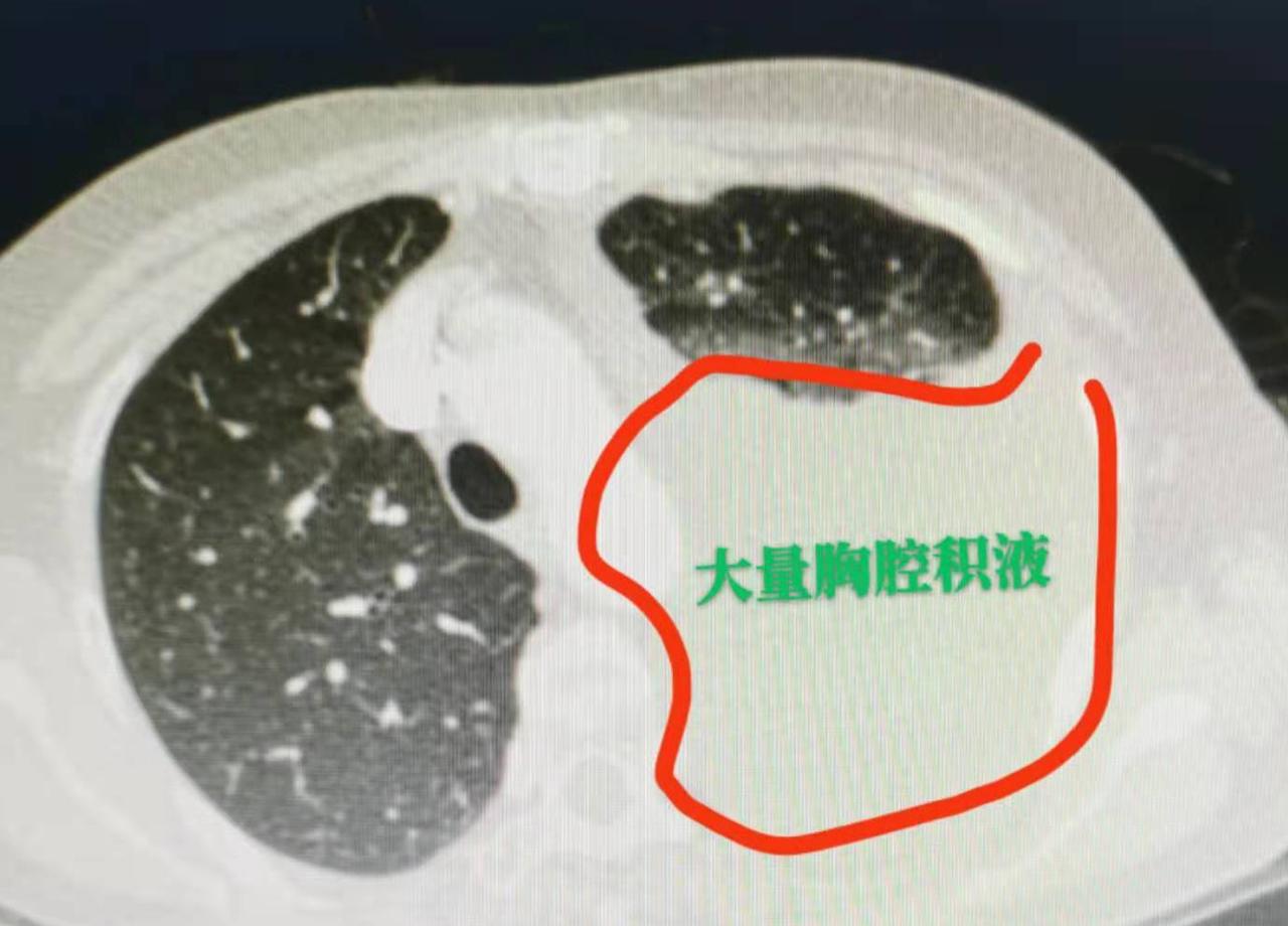 前段时间我接诊了一位50多岁的女患者，她平时身体看着挺好，没任何不舒服的地方，既