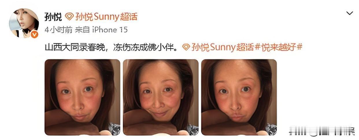 孙悦，太让人心疼了！

1月21日，歌手孙悦在微博上晒出一张照片，眼圈和脸颊冻的