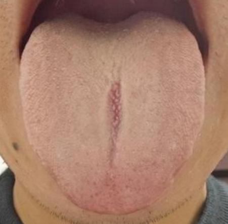 看看舌头都成啥样了，真是一点也不爱惜自己的身体啊！

患者平时急躁易怒，口干口苦