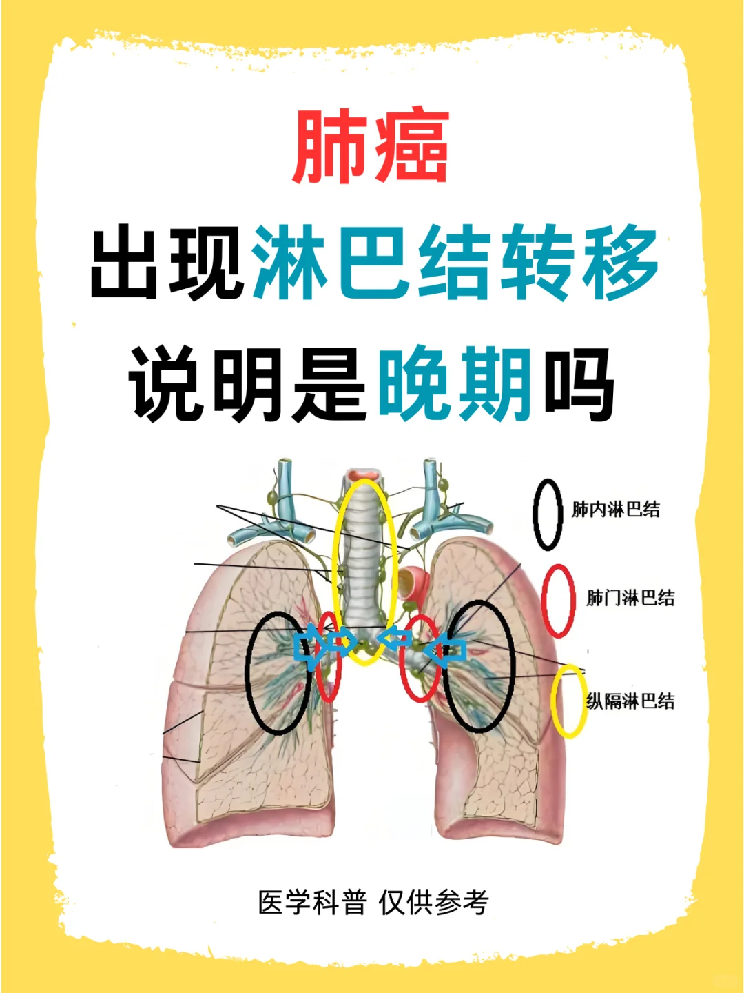 肺癌出现淋巴结转移说明是晚期吗？