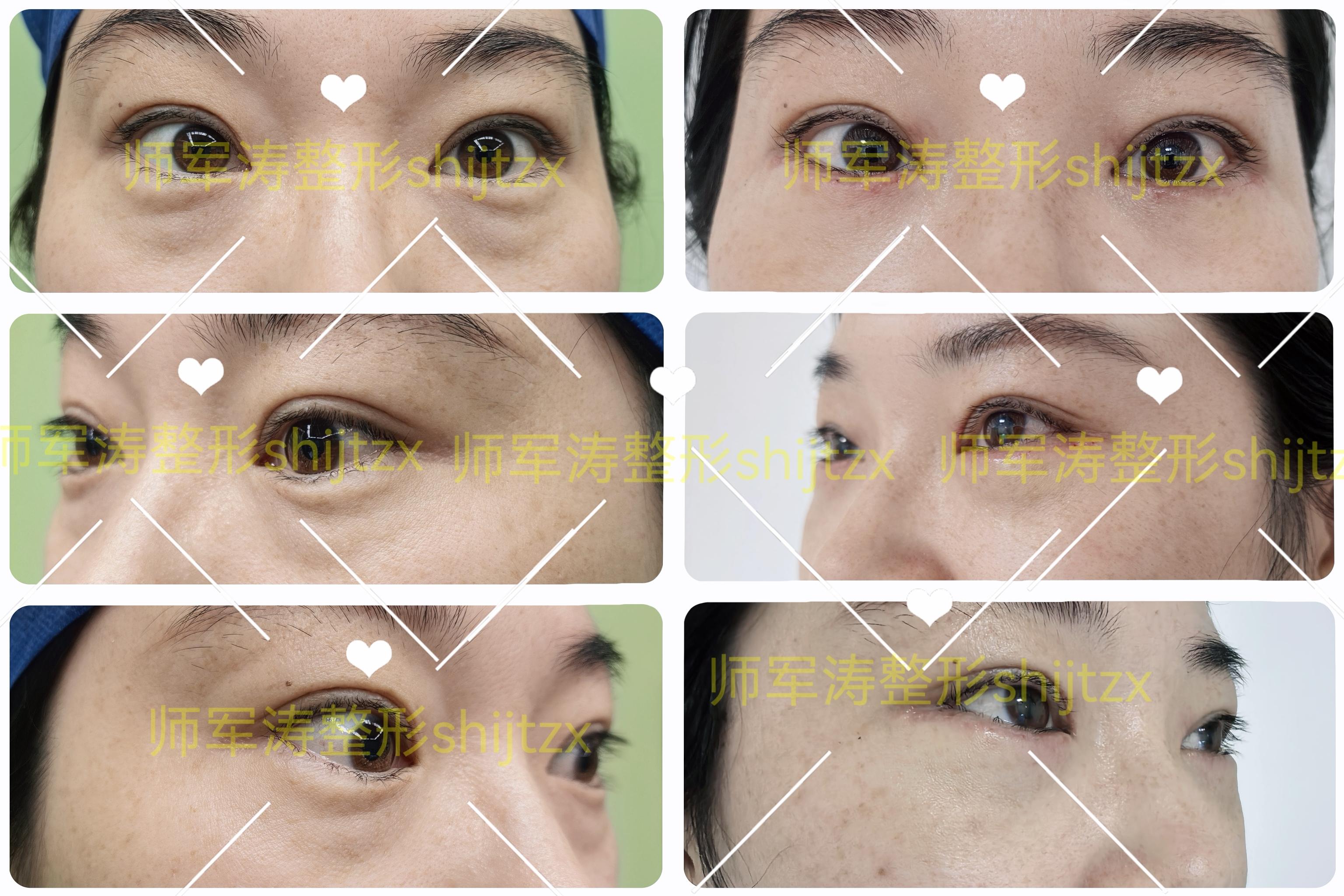 眼袋术后7天拆线即刻。