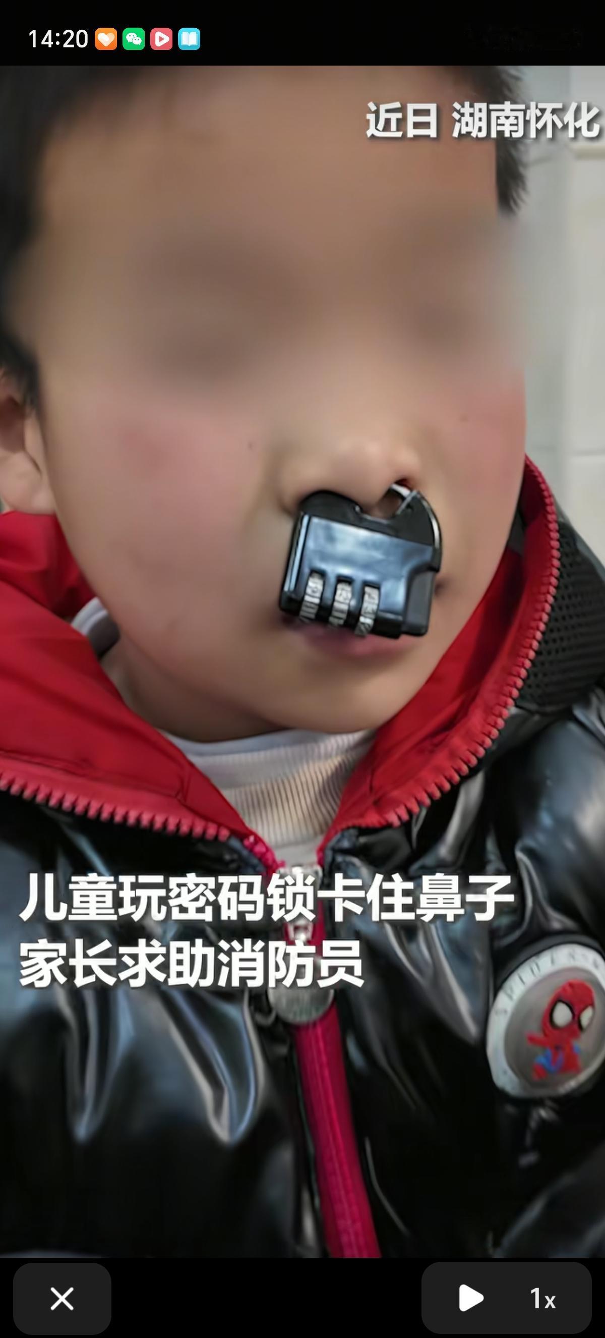 小孩哥闯祸总是能超乎想象，愣是给自己鼻子上了一把锁，关键是他还不知道密码，就卡住