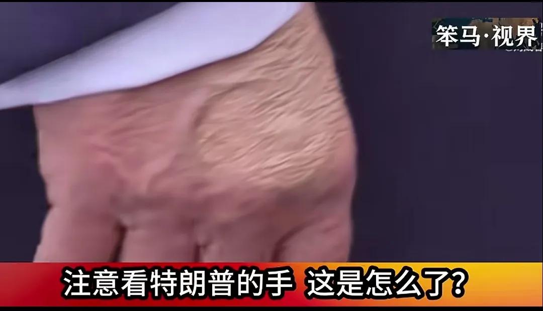 特朗普的手，这是怎么了？