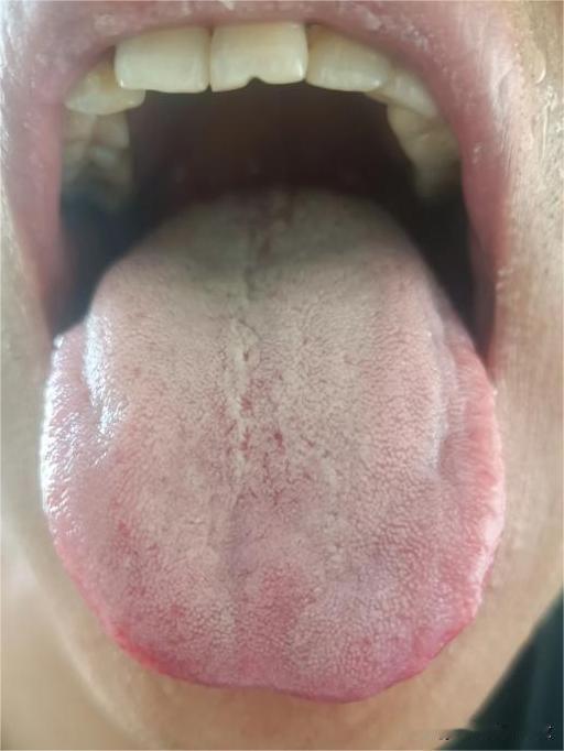 你看看你舌头肿的这么大，吃也吃不好，睡也睡不好[惊呆][惊呆]
放假也不出去玩，