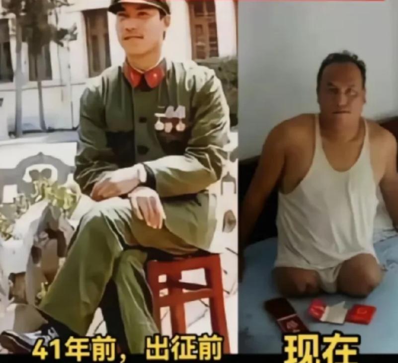 老山特级战斗英雄吴华，为了救战友,不幸踏中地雷，双腿炸伤严重，被迫双腿截肢。
 