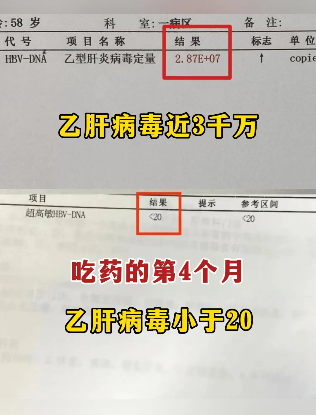 “乙肝20多年了，今天是抗病毒的第4个月！”今天山东潍坊的患者到院复查...