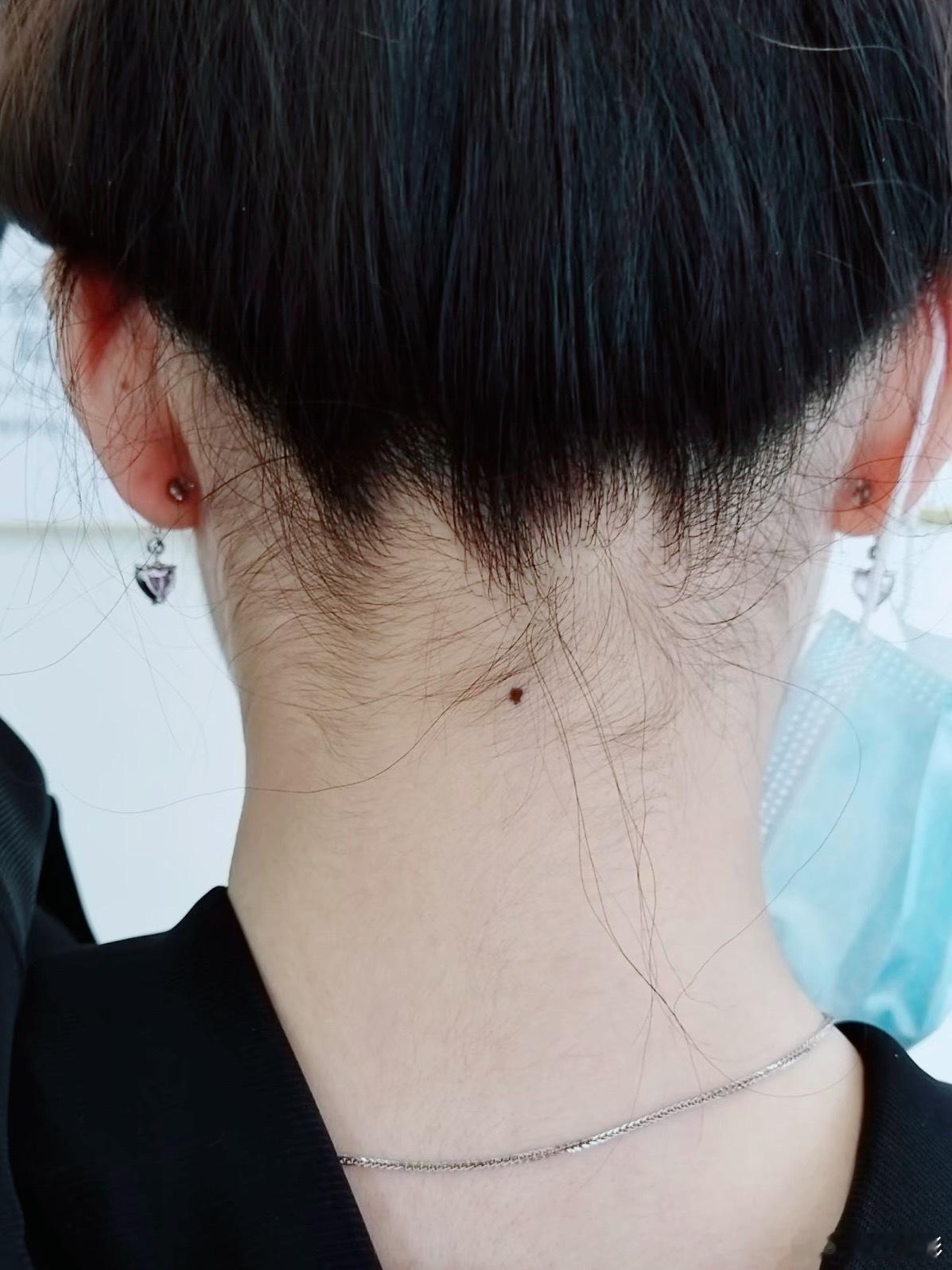 脖子后面有颗痣，是好是坏？
