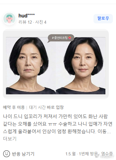 这才是有效拉皮最真实的状态，根本不是那种鼓鼓囊囊 又很紧的感觉