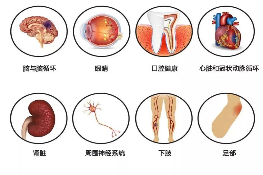 糖尿病并发症4种信号，别不当回事！1、神经信号；糖尿病周围神经 病变，可导致肢体