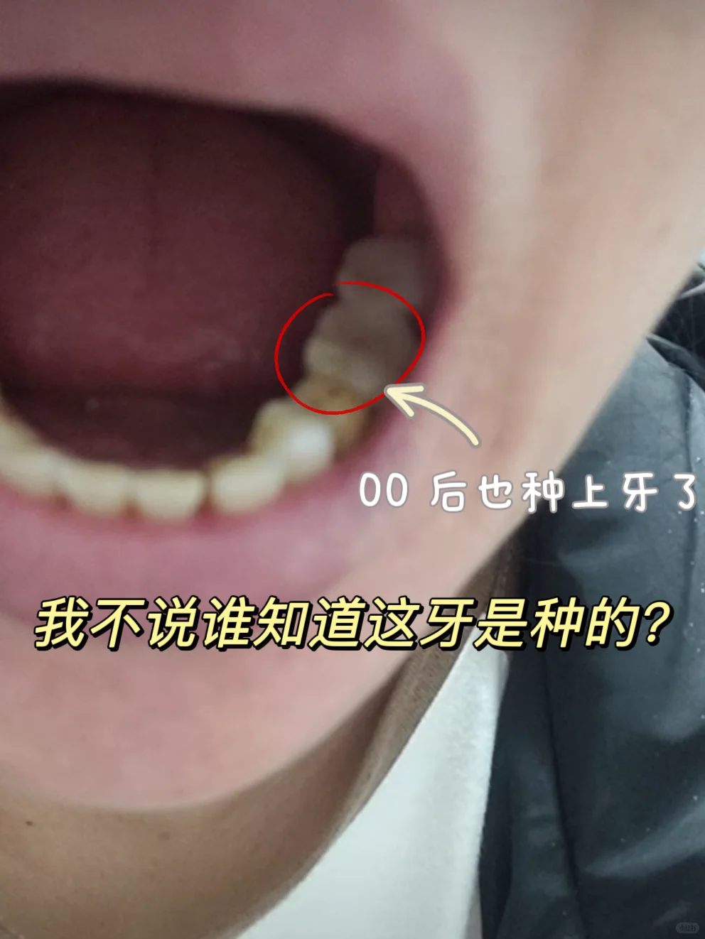 太原种牙找山大一院主任亲种iti花了5.2k