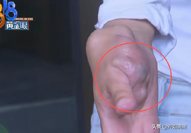 浙江杭州，山东德州的蔡女士为挣钱治右手血管瘤，辞去老家客服工作来杭州应聘。阿浩在