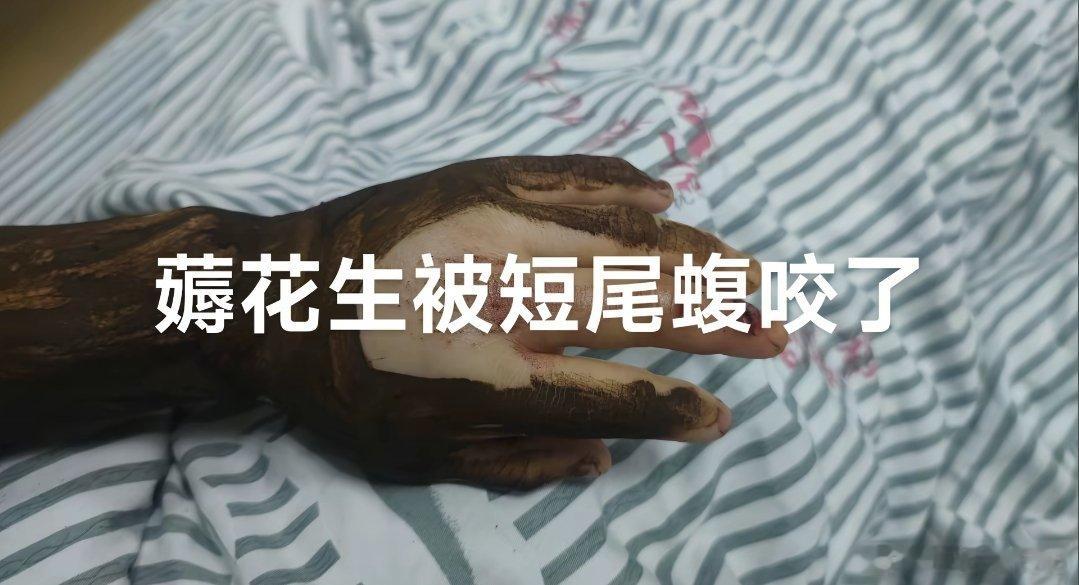 网友薅花生被短尾蛇咬了，今年河南这边雨水比较多，大家多注意点 ​​​