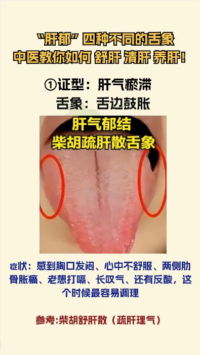 肝郁的几个阶段 看看你是哪一阶段