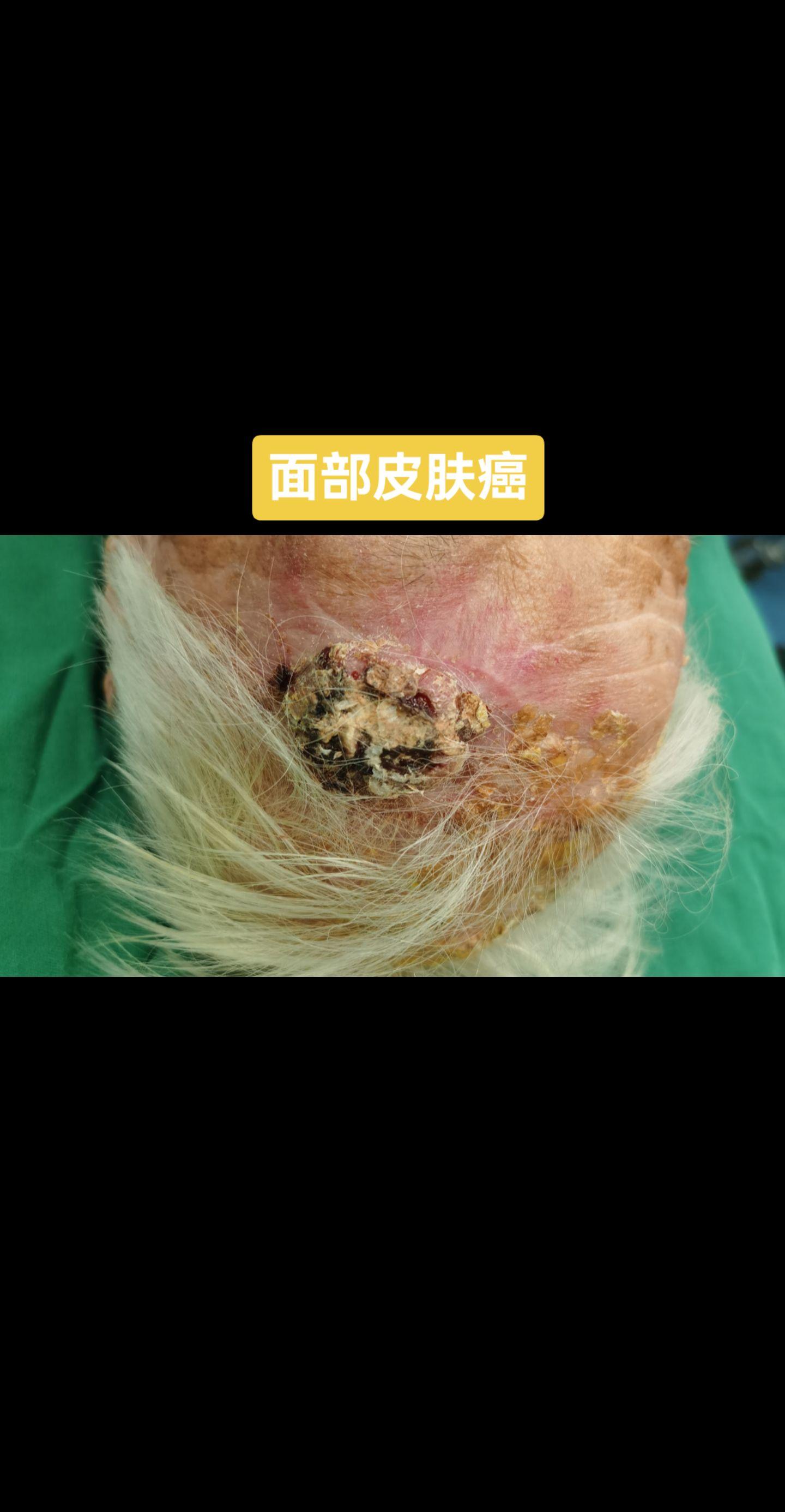 面部皮肤癌 一天3台面部皮肤癌手术。