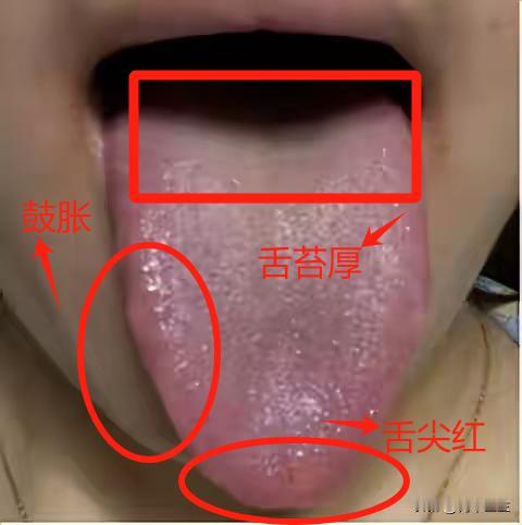 舌红莫补阳，朋友，你这舌头红成这样，是阴虚啊，可不敢再补阳了

今天我遇到了这样