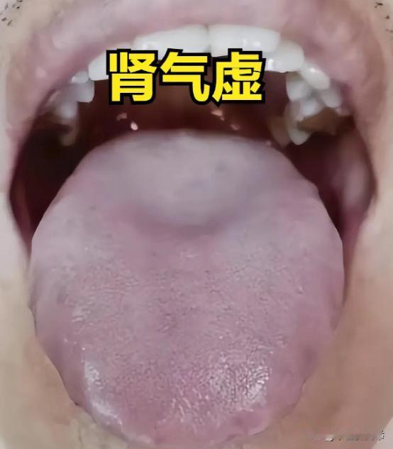 补肾填精，五子衍宗丸不是第一，它的三个“兄弟”，作用更强
1.金锁固精丸
表现：