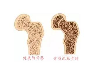 骨质疏松狂补钙？你很可能白花钱了 
 
直播间里咨询骨质疏松的，大多是35岁以上